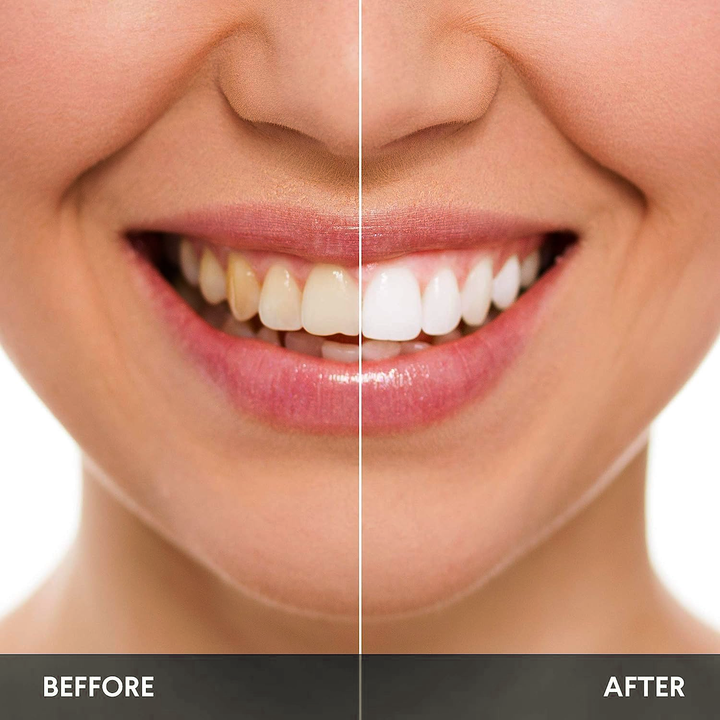 La beauté commence par le sourire: Un sourire sincère vaut plus que n’importe quel filtre ou maquillage. Mais beaucoup n’osent plus sourire, gênés par leurs dents. Glory Smile change ça. Pas de promesses, juste une solution visible, douce et efficace.